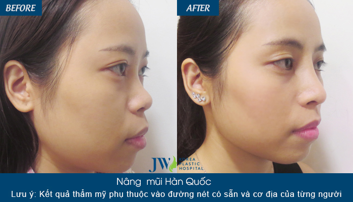 Nâng mũi Hàn Quốc ở đâu đẹp - 3 tiêu chí đánh giá bệnh viện uy tín- Ảnh 8