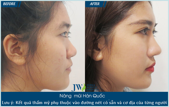 Nâng mũi Hàn Quốc ở đâu đẹp - 3 tiêu chí đánh giá bệnh viện uy tín- Ảnh 9