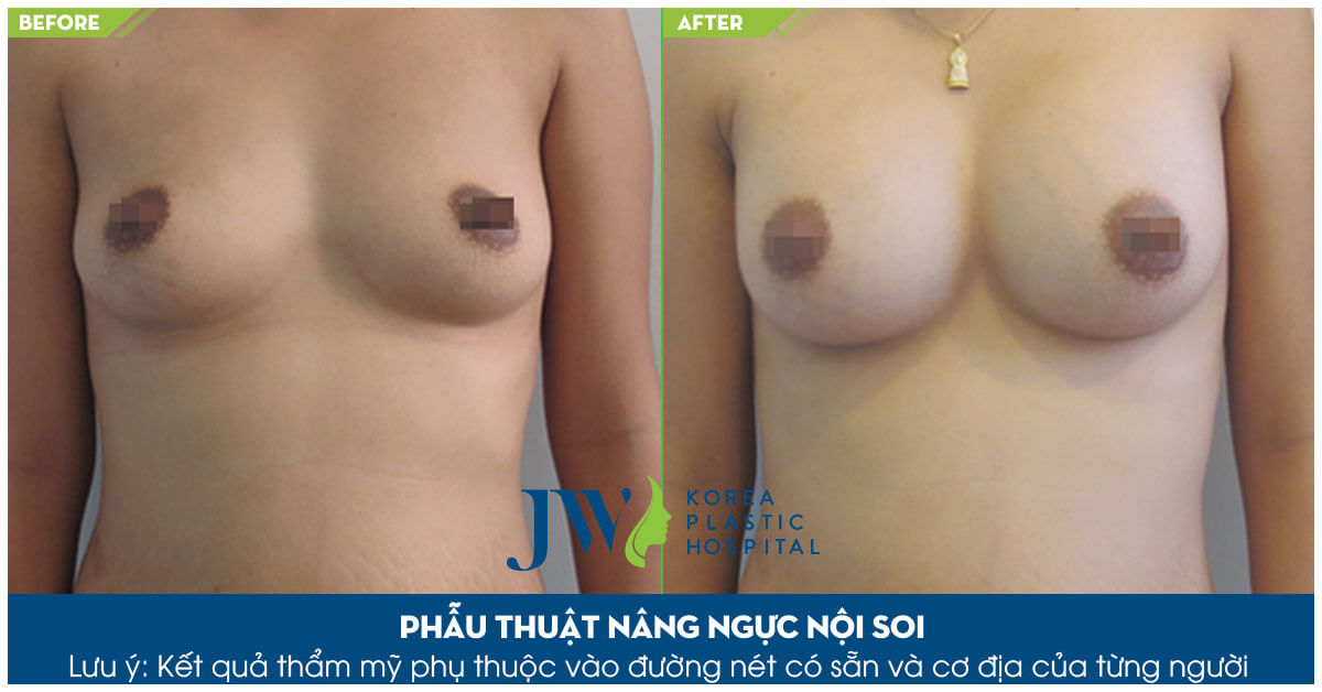 nang-nguc-noi-soi-2
