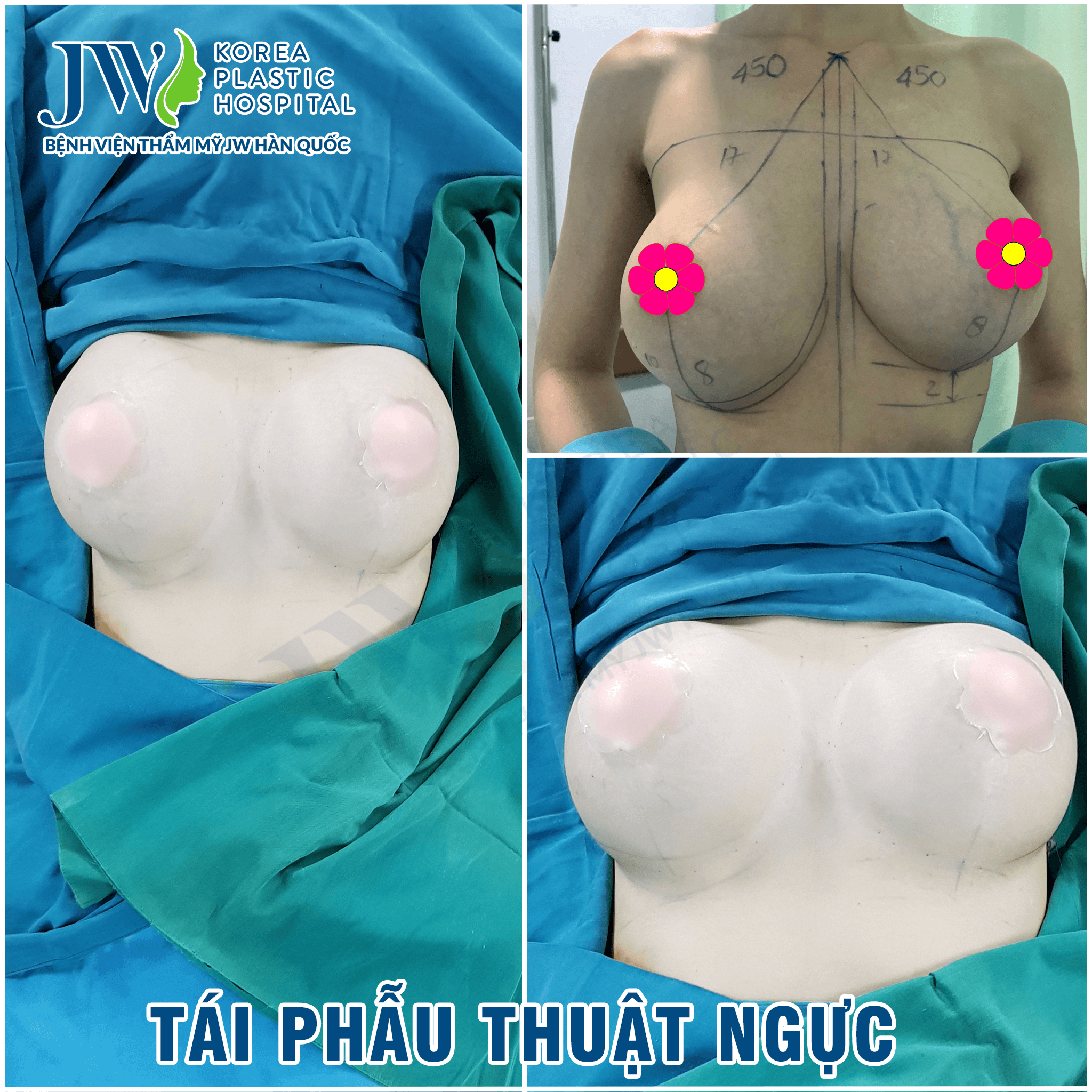 Nâng ngực 15 năm bị biến chứng, nữ Việt Kiều cầu cứu bác sĩ Việt Nam - Ảnh 4