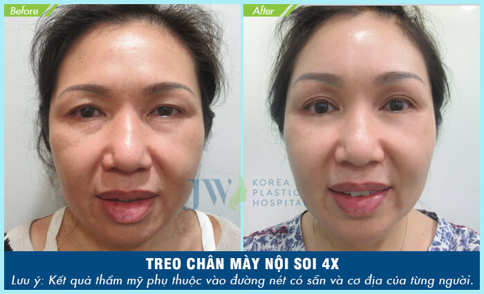Phẫu thuật thẩm mỹ mắt ở đâu tốt nhất-hình 17