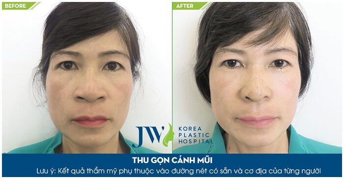5 lưu ý quan trọng khi phẫu thuật cắt cánh mũi - 