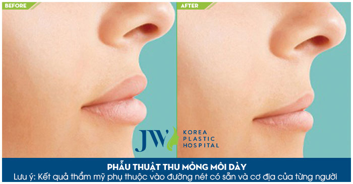 Thẩm mỹ môi dày thành mỏng_3