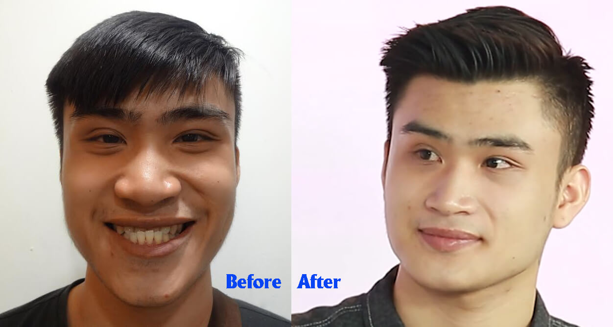 Chỉnh sửa khắc phục hàm móm như thế nào hiệu quả nhất-hình 8