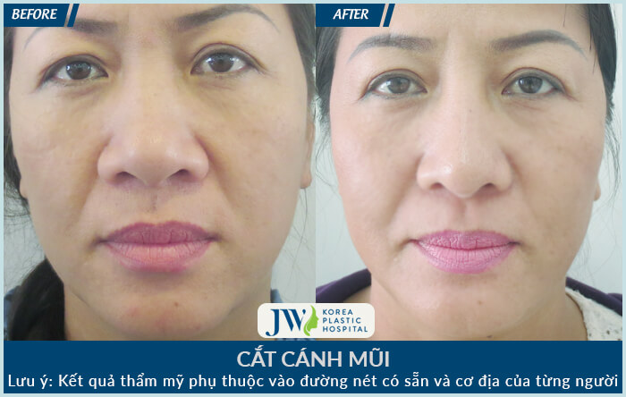 Phẫu thuật cắt cánh mũi có để lại sẹo không-hình 7