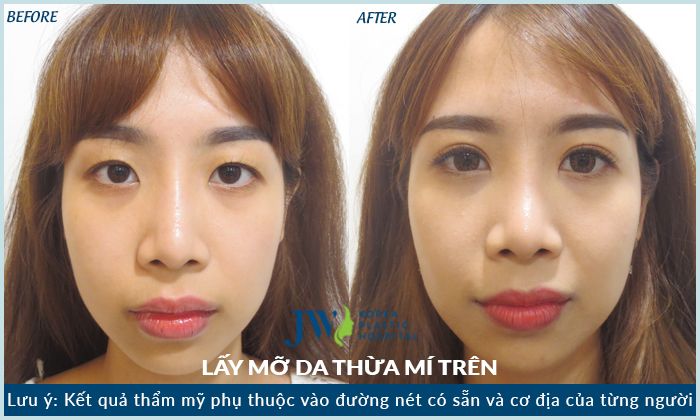 hình ảnh khách hàng sau khi cắt mắt hai mí