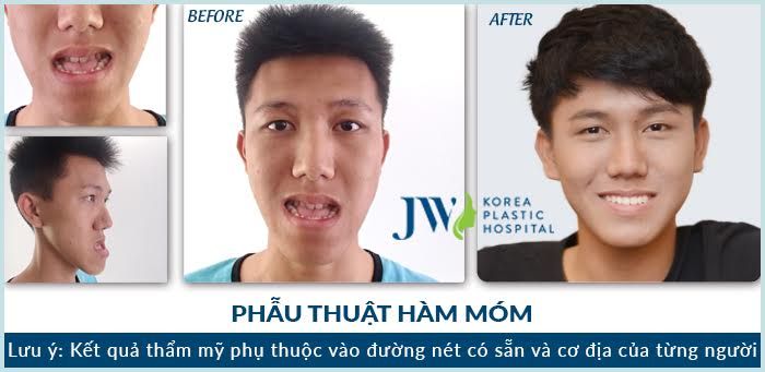 Chỉnh sửa khắc phục hàm móm như thế nào hiệu quả nhất-hình 7