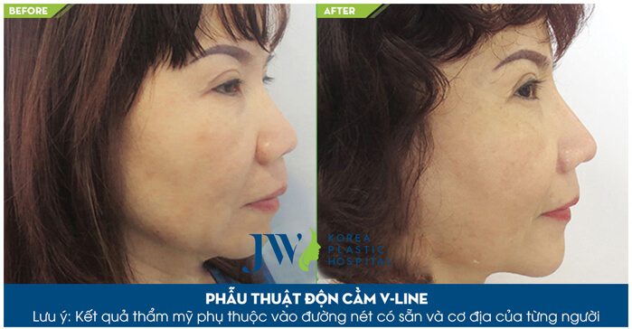 Độn cằm V Line ở đâu đẹp và an toàn-hình 9