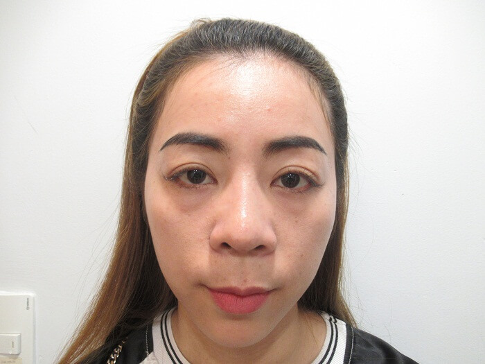 Đôi mắt buồn của Thu trước khi phẫu thuật
