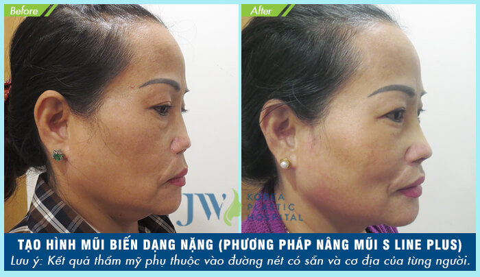 Bác sĩ sửa mũi đẹp nhất Sài Gòn - TS.BS Nguyễn Phan Tú Dung- Ảnh 3