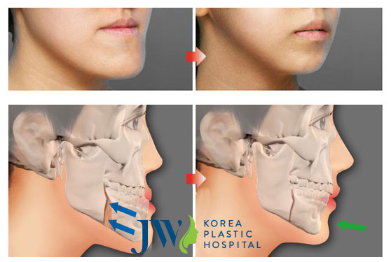 Chỉnh sửa khắc phục hàm móm như thế nào hiệu quả nhất-hình 3
