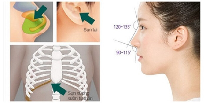 Nên nâng mũi bằng sụn tự thân hay sụn nhân tạo?-hình 3