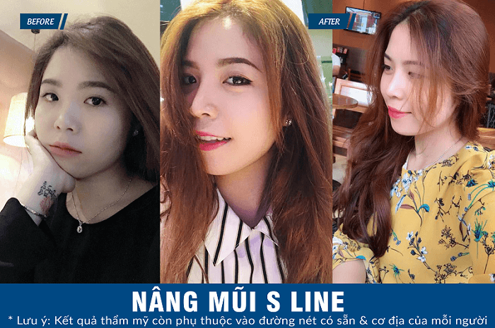 Bác sĩ nào nâng mũi đẹp nhất hiện nay_8