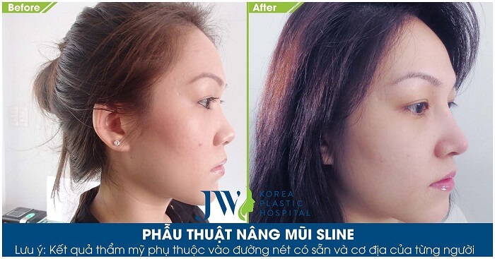 Nên nâng mũi bằng sụn nhân tạo hay sụn tự thân-hình 10
