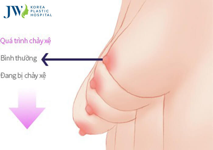 Nâng ngực chảy xệ_1