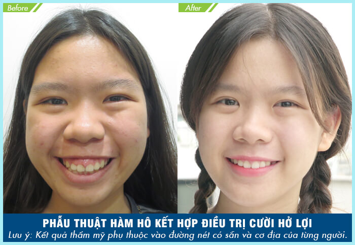 Điều trị hô móm trả góp và những điều cần biết-hình 8