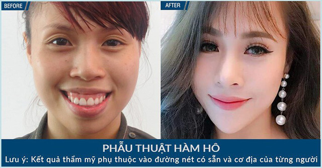 Điều trị hô móm trả góp và những điều cần biết-hình 6