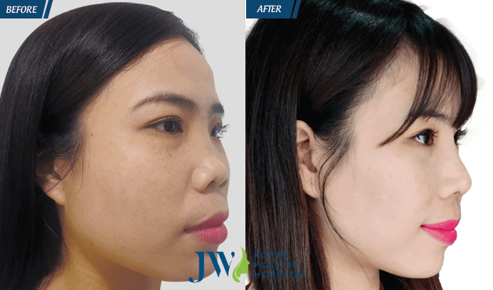 nâng mũi bằng sụn sườn