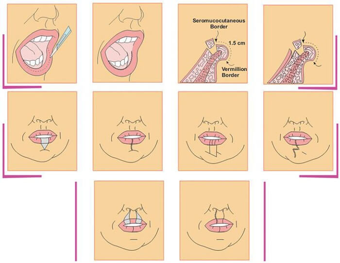 Thẩm mỹ môi dày thành mỏng_1