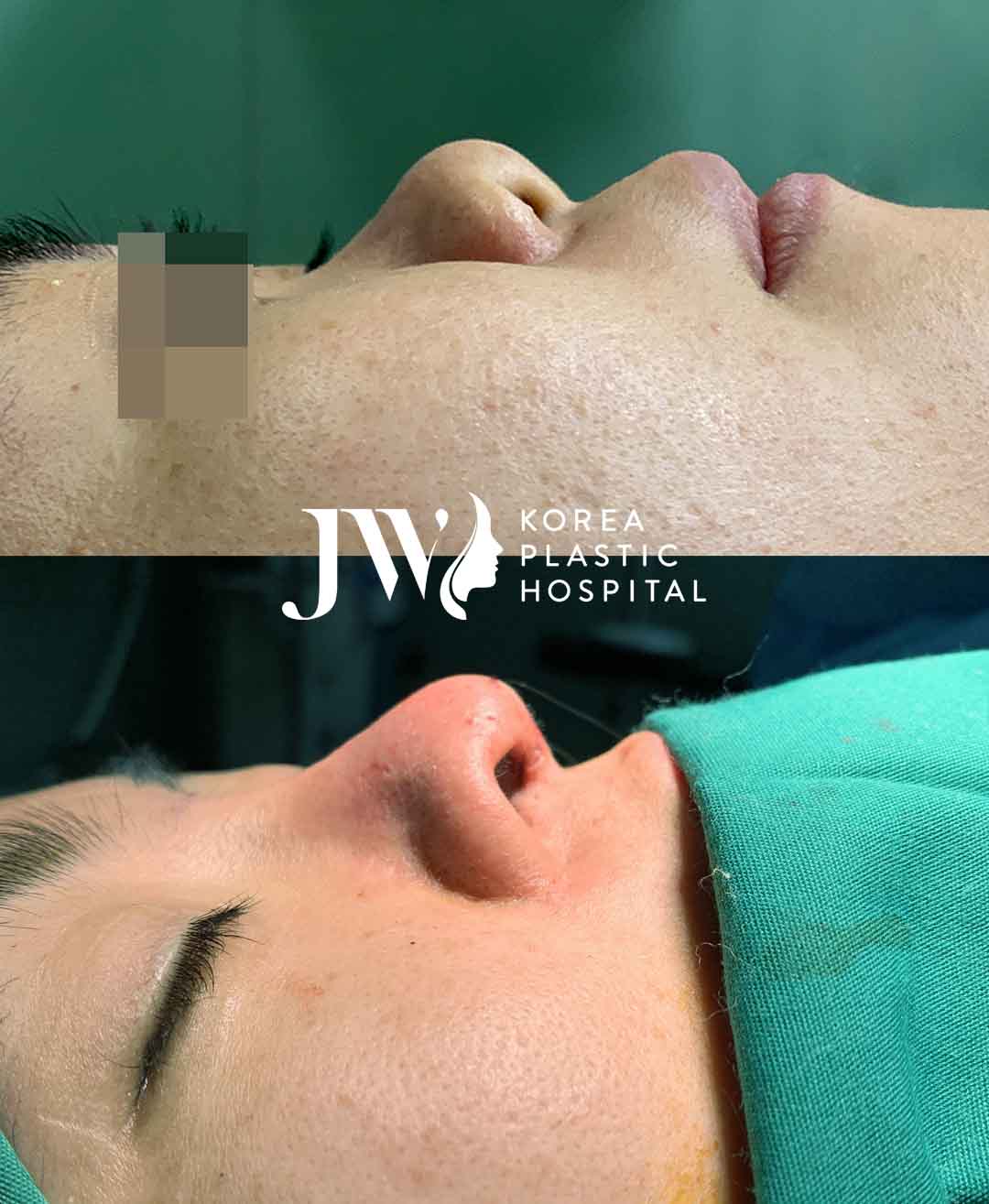 ưu điểm nâng mũi sụn sườn tự thân