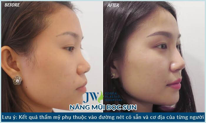 Phẫu thuật nâng mũi Hàn Quốc những điều quan trọng đừng bỏ lỡ - Ảnh 4