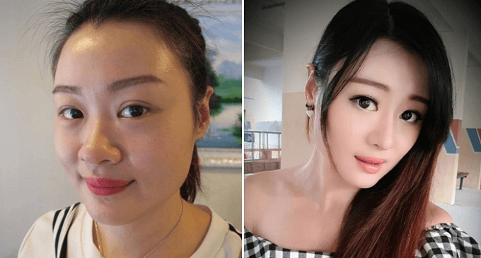 Phẫu thuật nâng mũi Hàn Quốc những điều quan trọng đừng bỏ lỡ - Ảnh 7