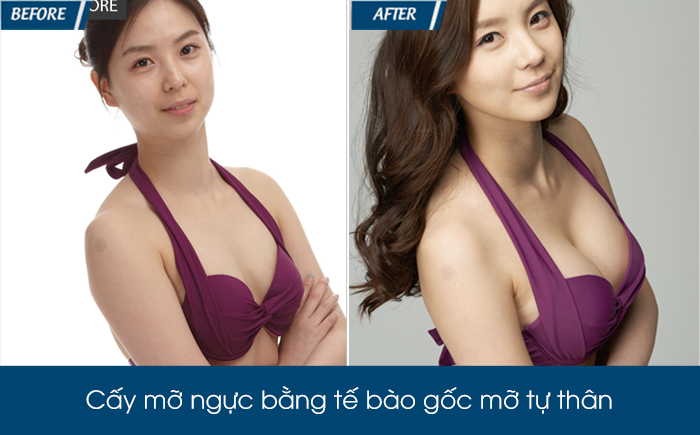 Nâng ngực mỡ tự thân tìm hiểu từ A-Z - Ảnh 7