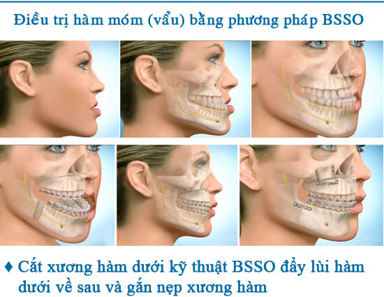 Có nên phẫu thuật hàm móm không-hình 2