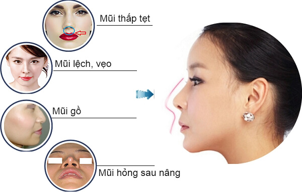 Nâng mũi có bị phá tướng không - Góc nhìn nhân tướng học - Ảnh 2