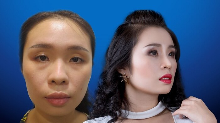 Phẫu thuật nâng mũi Hàn Quốc những điều quan trọng đừng bỏ lỡ - Ảnh 6