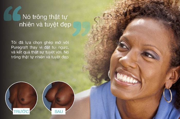 Nâng ngực mỡ tự thân tìm hiểu từ A-Z - Ảnh 3