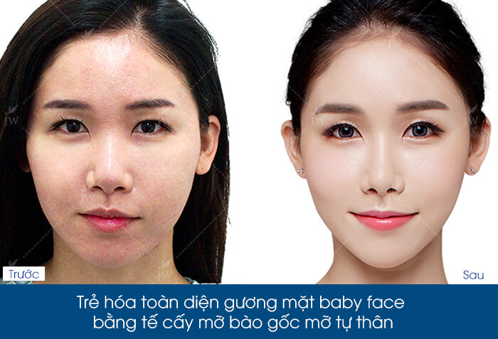Cấy mỡ tự thân lên mặt - Bí quyết vàng giữ mãi thanh xuân-hình 6