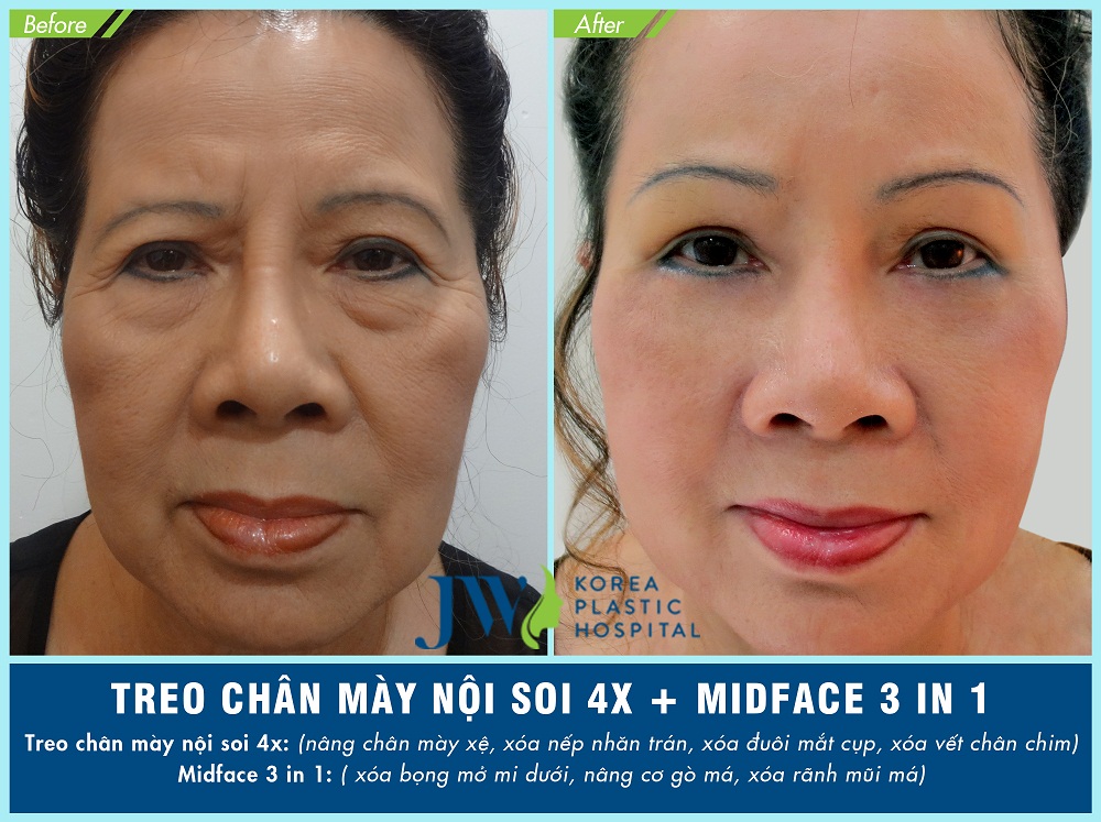 Treo chân mày có tác dụng gì? Nên thực hiện ở đâu?-hình 8
