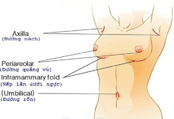 Nâng ngực nên chọn đường mổ nào-hình 2