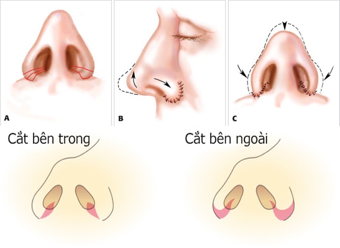 Phẫu thuật cắt cánh mũi có để lại sẹo không-hình 2