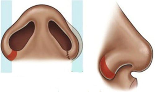 Cắt cánh mũi có vĩnh viễn không-hình 2