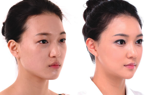 Cắt mắt to - 60 phút mắt đẹp chuẩn Hàn - Duy trì vĩnh viễn - Ảnh 8