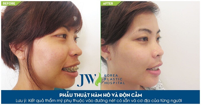 Giá độn cằm V Line - Công nghệ độc quyền Hàn Quốc - Ảnh 3
