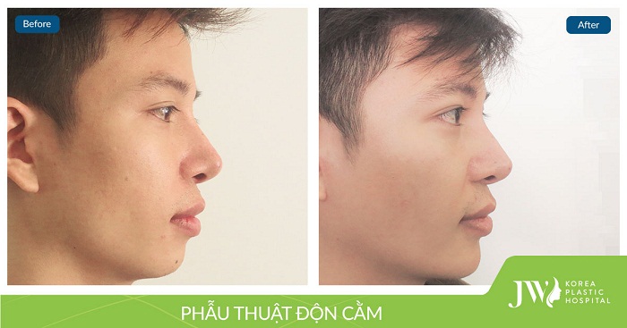 Kinh nghiệm độn cằm_7