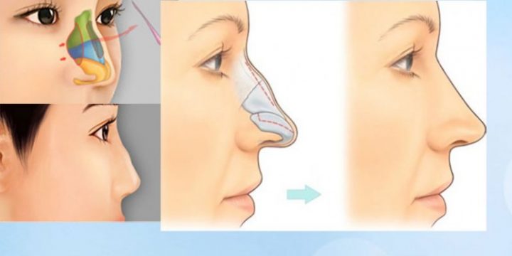 Bí quyết sửa mũi gồ an toàn và chuẩn đẹp-hình 2