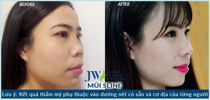 Nâng mũi S Line có đau không-hình 7