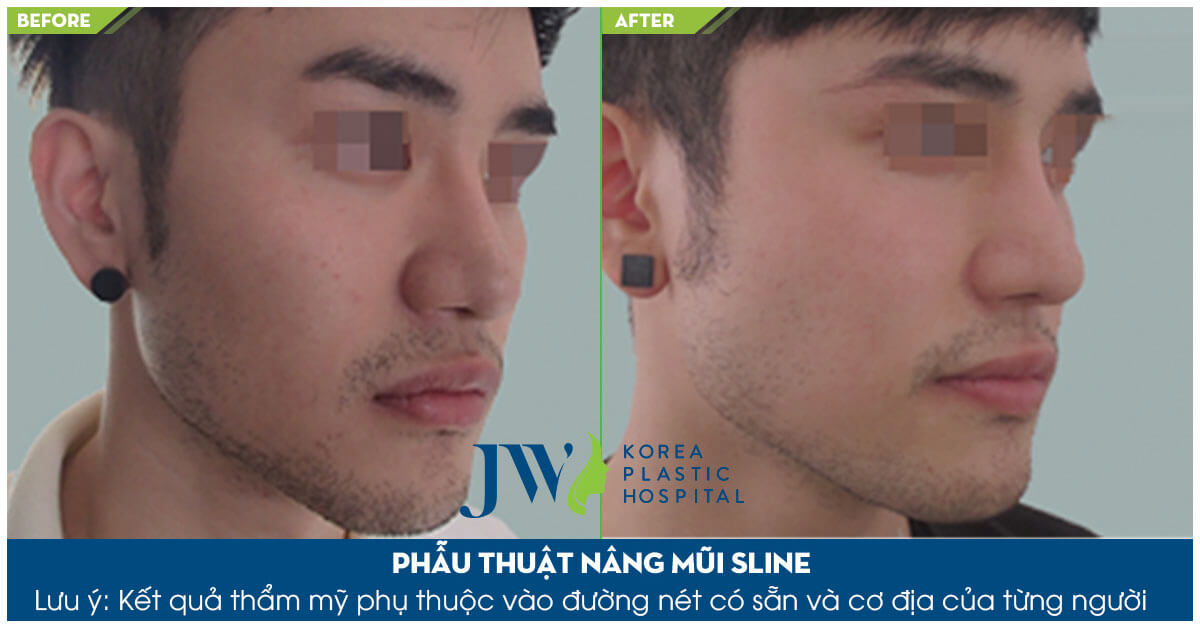 5 điều cần biết về sửa mũi nam an toàn-hình 7
