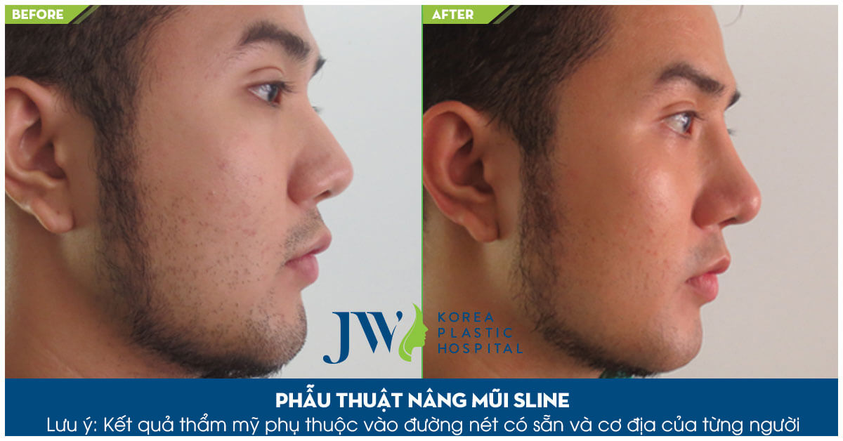 5 điều cần biết về sửa mũi nam an toàn-hình 5