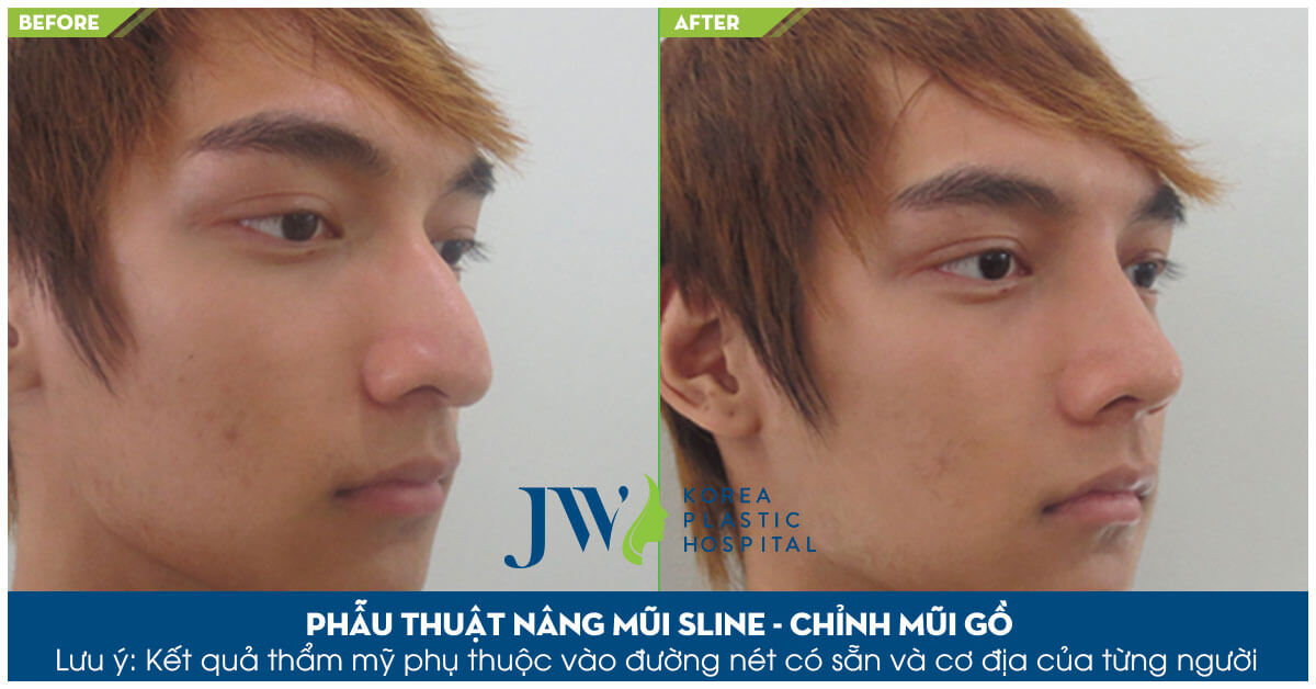 5 điều cần biết về sửa mũi nam an toàn-hình 6