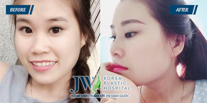 4 Điều không thể bỏ lỡ khi nâng mũi bằng sụn nhân tạo - Ảnh 5