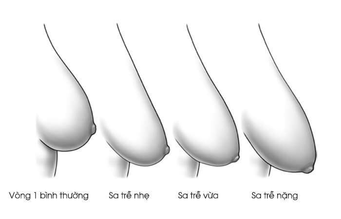 Nâng ngực chảy xệ bằng phương pháp nội soi - Ảnh 2