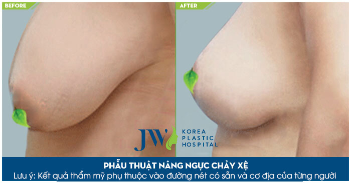 Nâng ngực chảy xệ bằng phương pháp nội soi - Ảnh 6