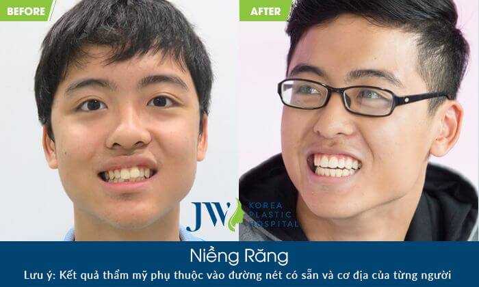 điều trị hô do răng với phương pháp niềng răng chỉnh nha - hình 3