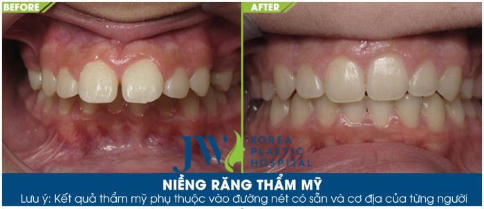 điều trị hô do răng với phương pháp niềng răng chỉnh nha - hình 2