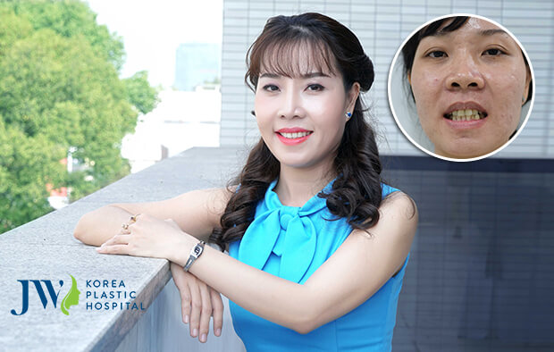 phẫu thuật hàm hô móm kết hợp niềng răng hình 3